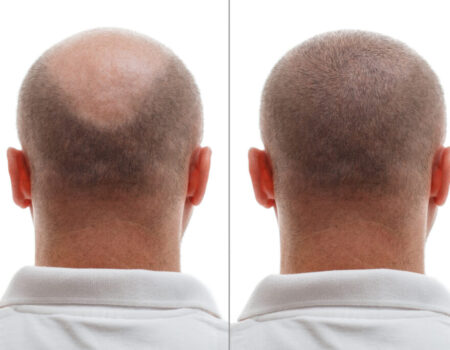 The head of a balding man before and after hair transplant surgery. A man losing his hair has become shaggy. An advertising poster for a hair transplant clinic. Treatment of baldness.